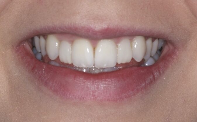 After - Westcountry Dental and Implant Centre